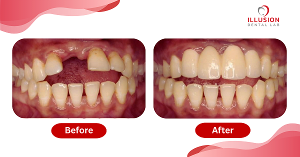 IDL - Before and After